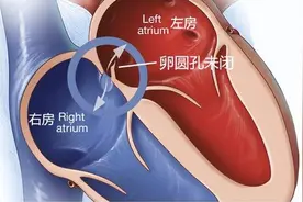 五问 - 卵圆孔未闭图片