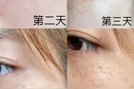 皮秒祛斑后恢复过程（实拍无美颜）图片