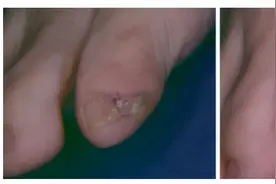 小脚趾甲分两瓣是什么原因？是山西人后代？医生给出了解释图片