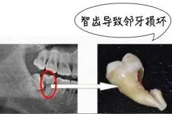 【健康科普】智齿的去与留？图片