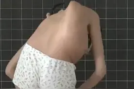 11岁“麻花女孩”李洁智力低于2岁，后背植入30颗螺钉，后来怎样图片