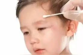 孩子受伤后留下疤痕，做好这3点，能让它变淡图片