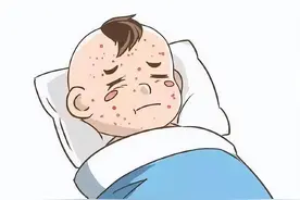 答疑解惑 | 关于水痘那些事儿图片