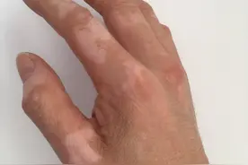 虫斑、汗斑和白癜风3大白斑怎么查？检查单子显示阴性代表什么？图片