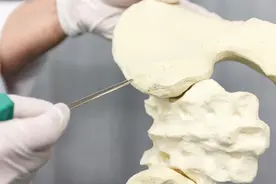 一文了解｜骨水泥是什么？要住院几天？术后注意事项？图片