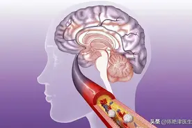 5个症状提示脑供血不足！提醒：不想脑梗或痴呆，提前做好4件事图片