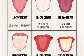 中医舌诊，观舌苔晓健康，常见6种舌象，一起来学学！图片