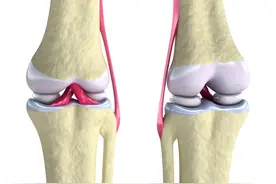 一文了解创伤性关节炎什么是创伤性关节炎？图片