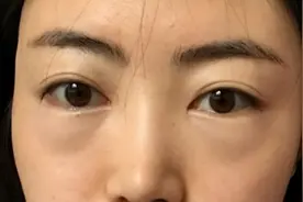 切掉眼袋到底能给一个人带来多大变化？整形医生给你解答图片