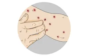 身上起了“小红点”，究竟是什么？原因给你列出来了，对照看看图片