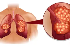 提醒：中老年人出现这6种表现，可能发生了癌症，该做做检查了图片