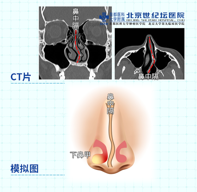 走进鼻子系列——治疗鼻炎之后策 手术篇