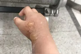 带娃去公园散步，1岁的孩子却莫名被毁容！伤口如同被泼硫酸…图片