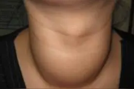 甲亢不是小问题，别光顾着“大脖子”图片