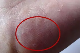 这种皮肤病常被误以为是“脚气”，很痒很尴尬！还容易反复发作图片