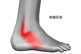 崴脚后，脚踝外侧一直疼痛，什么是腓骨肌腱损伤，严重吗？图片