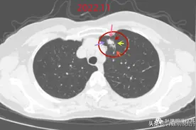 肺结节良恶性难定？细节对比分析揪真相图片