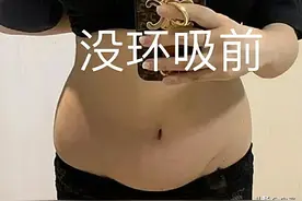 小学老师体验腰腹环吸，术后3天分享图片