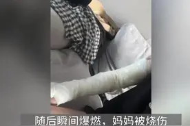 广东：男孩玩气球砸到吹风机爆燃，妈妈被烧伤后皮肤大面积缺失图片