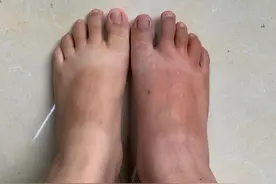 火红蚁咬一下，脚就肿了图片