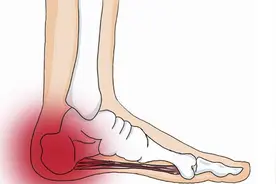 走路脚后跟疼？别再轻视！医生提醒：可能与这4种病有关，别拖延图片