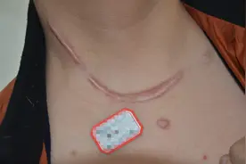 郑州市第二中医院科普：增生疤痕危害有多大？图片