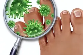 真菌感染该如何预防和治疗，尤其是足部真菌感染？图片