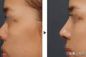 美容店老板花8万做鼻子，结果整成“猪鼻子”，事业家庭遭重创图片