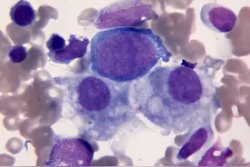 骨髓穿刺真的很可怕吗？今天来了解下图片