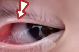 8个月男婴眼睛取出8条寄生虫图片