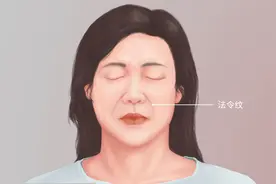 什么是法令纹图片