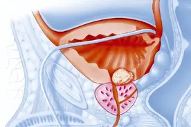 发现多为晚期的前列腺癌，除了手术，还有这一招图片