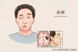 【健康科普】关于面神经炎图片