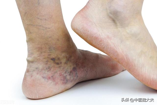 再次提醒：腿上有这种“红血丝”的人，可能是身体发出的危险信号