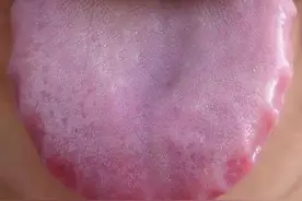 齿痕舌，舌苔厚，是百病祸根！参苓白术丸巧搭配，断祸根 还你健康图片