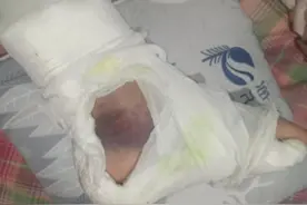 三踝骨折有多可怕（一）图片