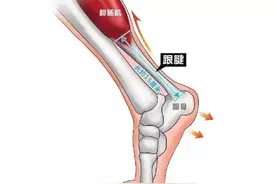 别让运动爱好成“梦魇”，跟腱断裂知识要储备好图片
