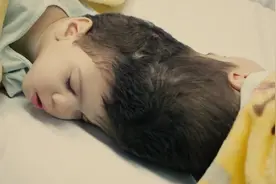 巴西头颅相连的双胞胎成功分离！为此医生们戴着VR头盔练了几个月图片