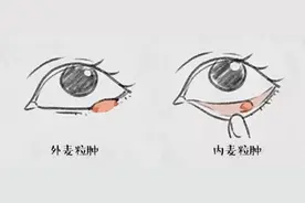 长了针眼（麦粒肿）怎么办？医生分享一个快速消除的方法图片