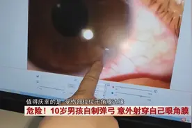 危险！10岁男孩上网学自制弹弓，意外射穿眼角膜图片