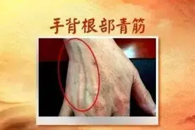 青筋突出问题严重吗？什么原因？怎么应对？图片