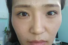 面部脂肪填充10天后“大变样”，幼态、紧致，柔和中带点气质图片