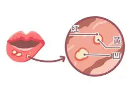 口腔溃疡，可以吃阿莫西林吗？图片