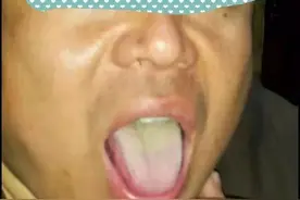 滋阴法治疗舌苔厚腻图片