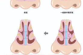 鼻中隔偏曲不矫正会越来越严重吗？手术痛吗？主任医师来给你解答图片