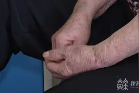 78岁老人几近失明 人工角膜移植后重获视力图片