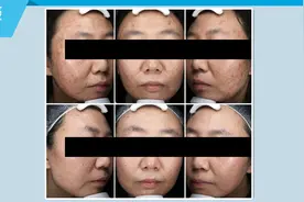 黄金微针，怕不是有什么缩毛孔牛逼症吧？图片