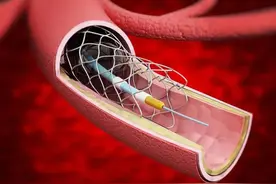 装上心脏支架后，还能活多少年？医生不再隐瞒，建议提前了解图片