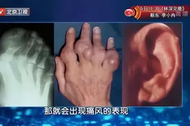 餐桌上的“嘌呤大户”，比肉类、海鲜还要高！这些食物都得少吃图片