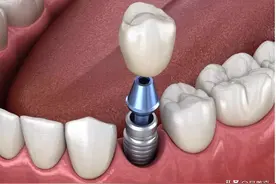 种植牙经历——公私立医院/牙科门诊的选择图片